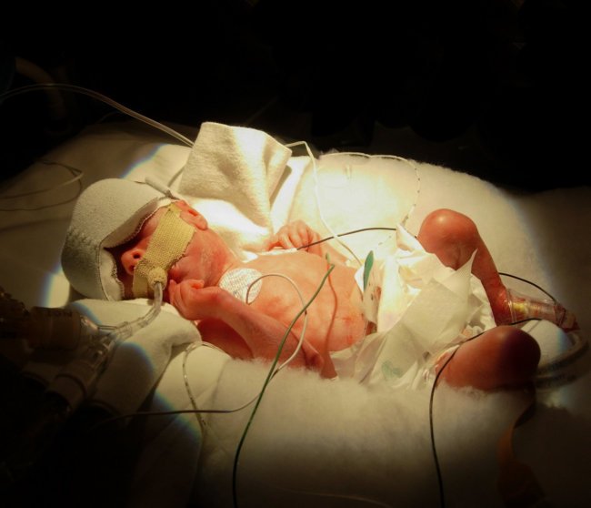 New born premature baby
